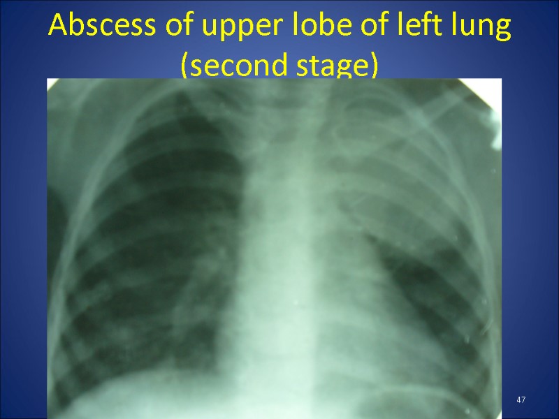 Abscess of upper lobe of left lung (second stage) 47